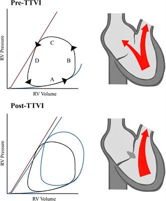 Time to assess more than prognosis: advancements and challenges in transcatheter tricuspid valve interventions